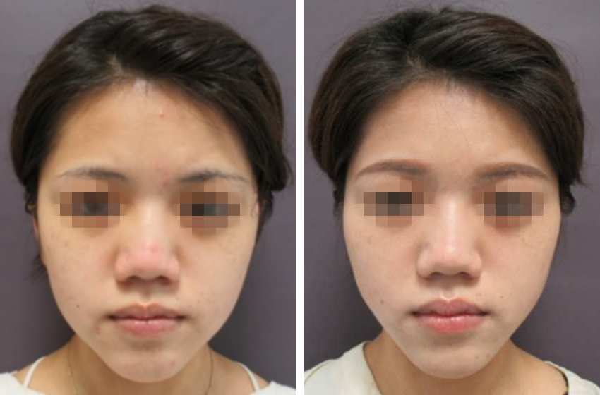 口元のもたつきをスッキリ改善