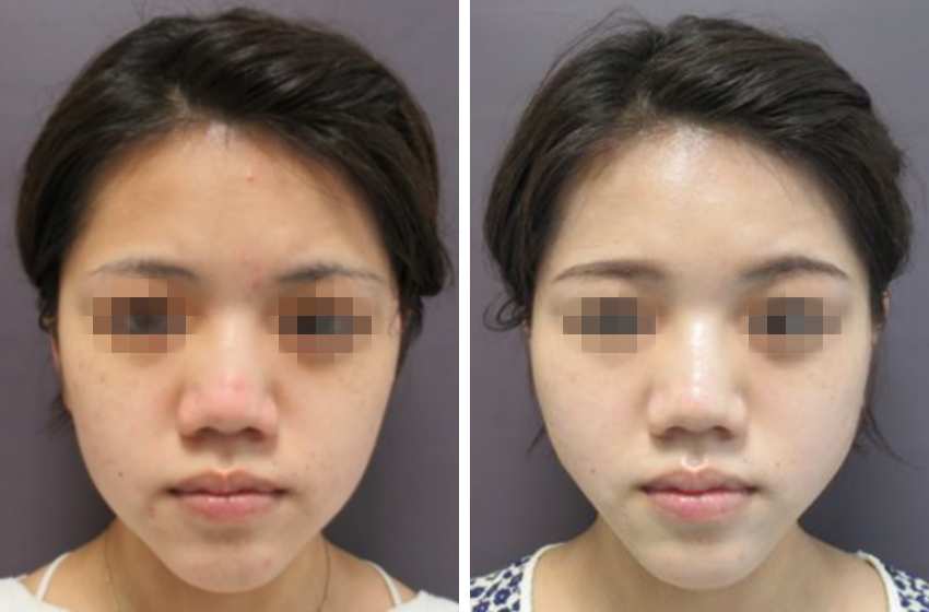 TAC式 ツヤ肌コラーゲンリフト®/バッカルファット除去の症例写真 施術前後 １週間後