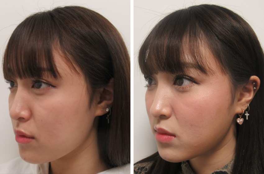 TAC式 ツヤ肌コラーゲンリフト®/バッカルファット除去/エラボトックス注射の症例写真 施術前後 １ヵ月後
