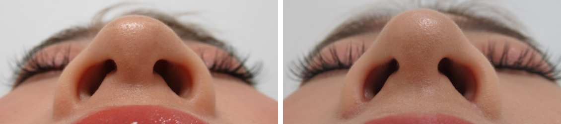 TAC式 鼻翼縮小術（小鼻縮小）/鼻尖形成・鼻尖縮小/ヴィーナスノーズ（切らない鼻中隔延長術）の症例写真 施術前後 １ヵ月後