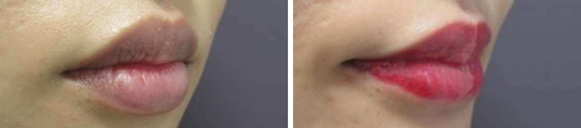 M字リップ形成術/口唇縮小術の症例写真 施術前後 2ヶ月後