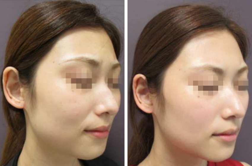 メーラーファット除去の症例写真 施術前後 1ヶ月後