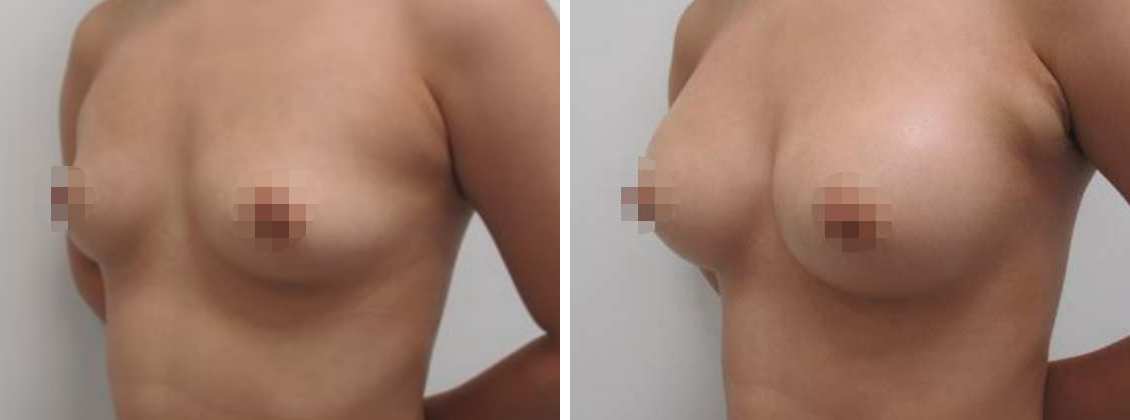 ヒアルロン酸注入豊胸術（グラビアバスト）の症例写真 施術前後 直後