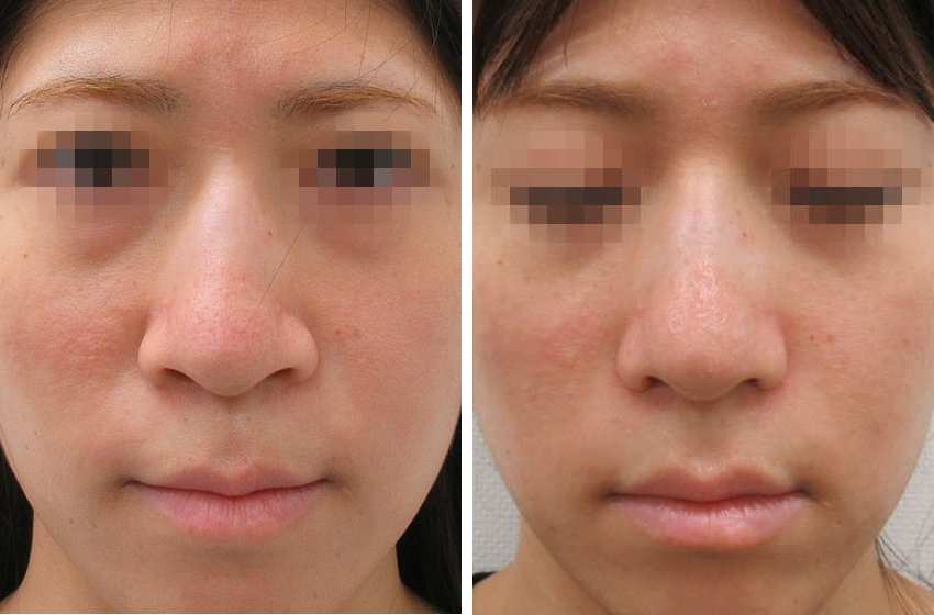鼻翼縮小術ですっきり小鼻に