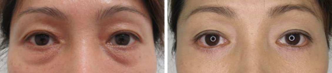 下眼瞼切開術と脱脂術で目元のアンチエイジング