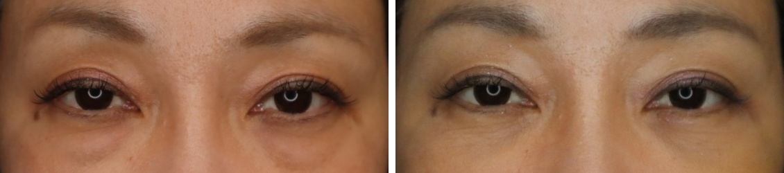 下眼瞼脱脂術（目の下のたるみ取り・目の下の脂肪ふくらみ取り）の症例写真 施術前後 1ヵ月