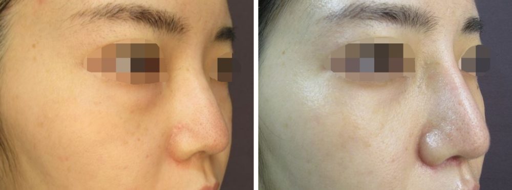 隆鼻術オーダープロテーゼ、鼻尖縮小術、鼻尖４Dノーズで鼻筋の通ったお顔に