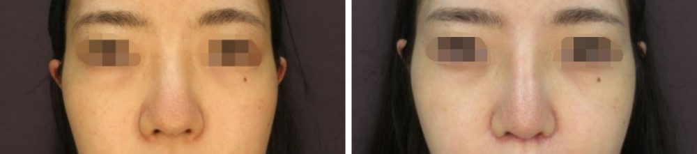 隆鼻術（プロテーゼ・自家組織）/鼻尖4Dノーズ/鼻尖形成・鼻尖縮小の症例写真 施術前後 １カ月