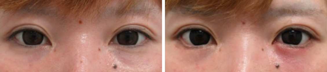 グラマラスライン(タレ目形成)/目尻切開術の症例写真 施術前後 1ヵ月後