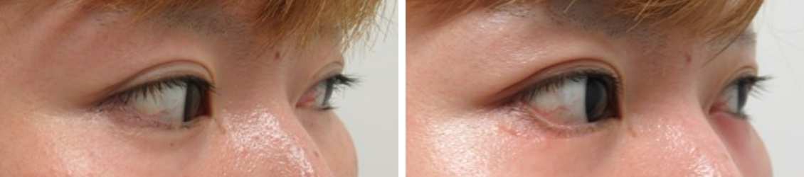 グラマラスライン(タレ目形成)/目尻切開術の症例写真 施術前後 1ヵ月後