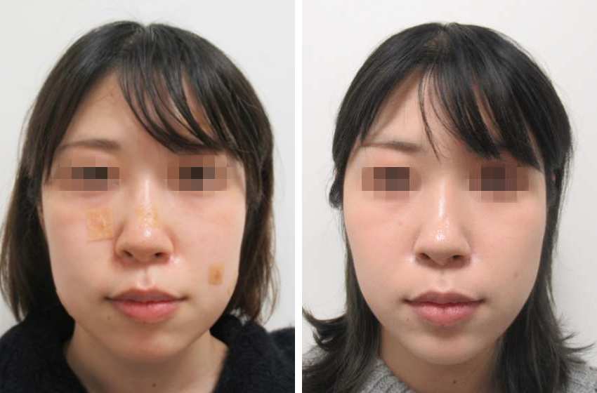 複合施術でひと回り小顔に