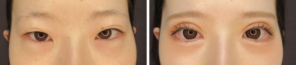 二重全切開法+目頭切開術+グラマラスライン形成でとても華やかなお目元に