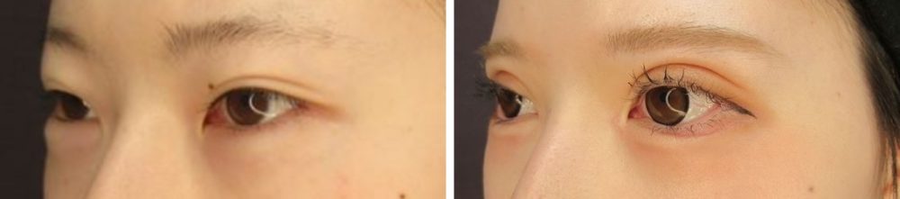二重切開（全切開法）/目頭切開術/グラマラスライン（タレ目形成）の症例写真 施術前後 １カ月後