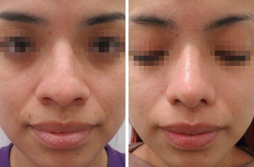 TAC式 鼻翼縮小術（小鼻縮小）/鼻尖4Dノーズ/鼻尖形成・鼻尖縮小の症例写真 施術前後 1ヵ月