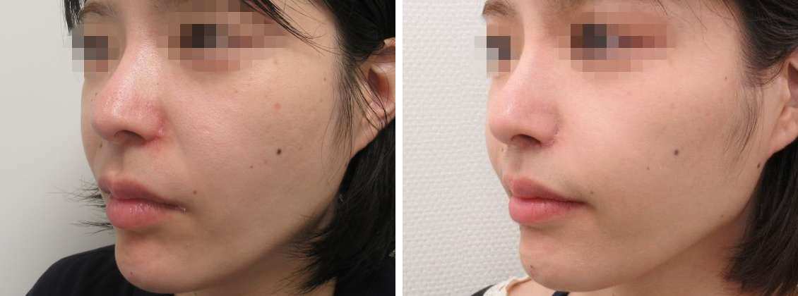 人中短縮術(リップリフト)・外側人中短縮術/TAC式 鼻翼縮小術（小鼻縮小）/Cカール・猫手術の症例写真 施術前後 3ヶ月後