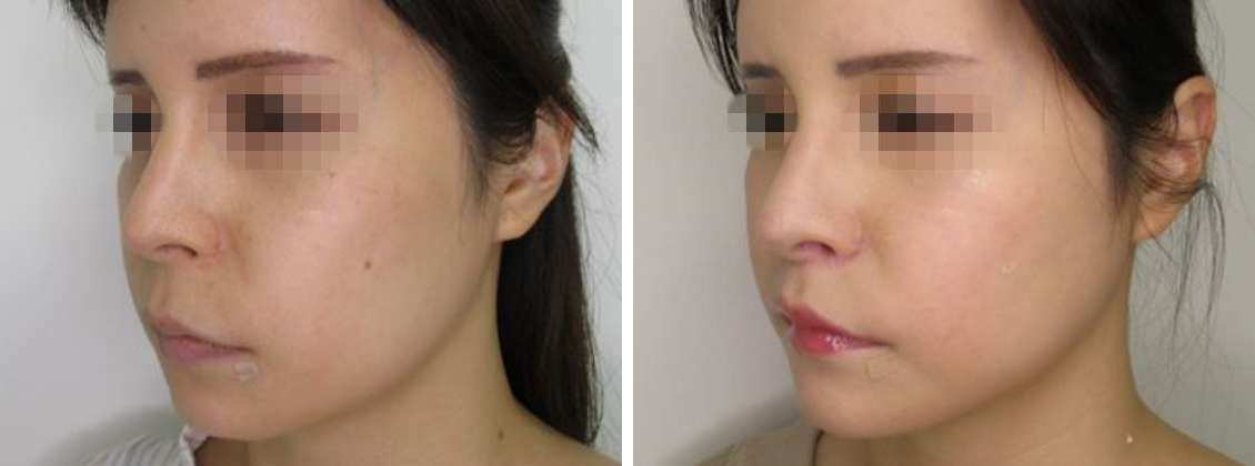 人中短縮術(リップリフト)・外側人中短縮術/TAC式 ツヤ肌コラーゲンリフト®/バッカルファット除去の症例写真 施術前後 1ヶ月後