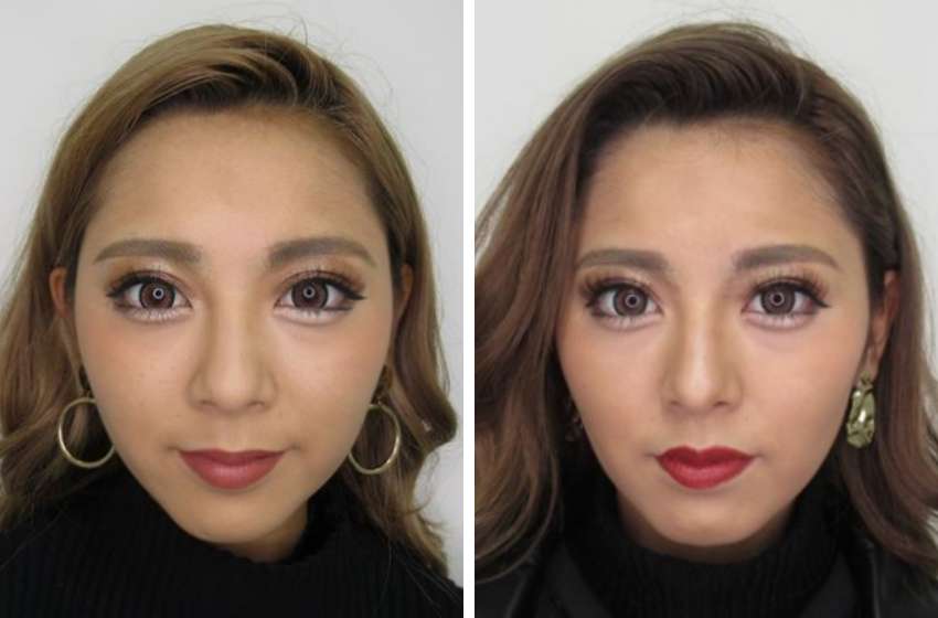 バッカルファット除去でさらに小顔に！