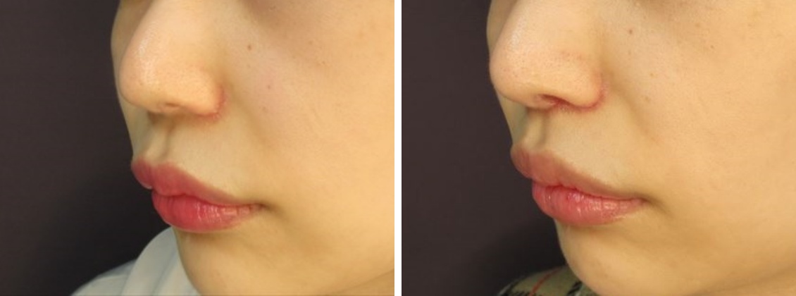 TAC式人中短縮術で可愛さアップ