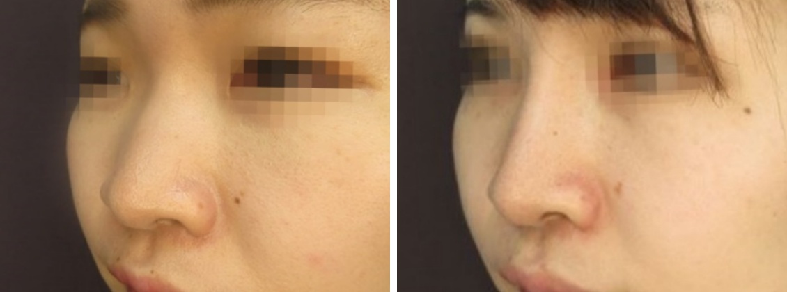 鼻プロテーゼで横顔美人に