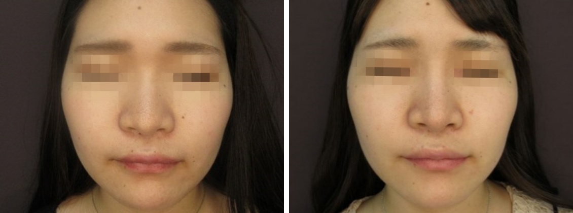 隆鼻術（プロテーゼ・自家組織）の症例写真 施術前後 1ヵ月