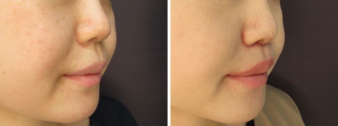 人中短縮術(内側+外側)で垢抜けフェイスに