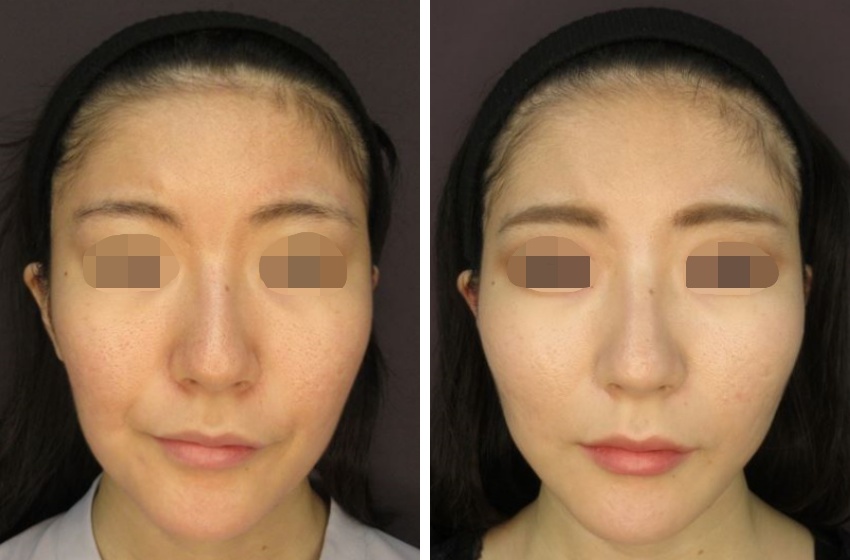 ツヤ肌コラーゲンリフトでお顔の重心が上に行き、若返りました