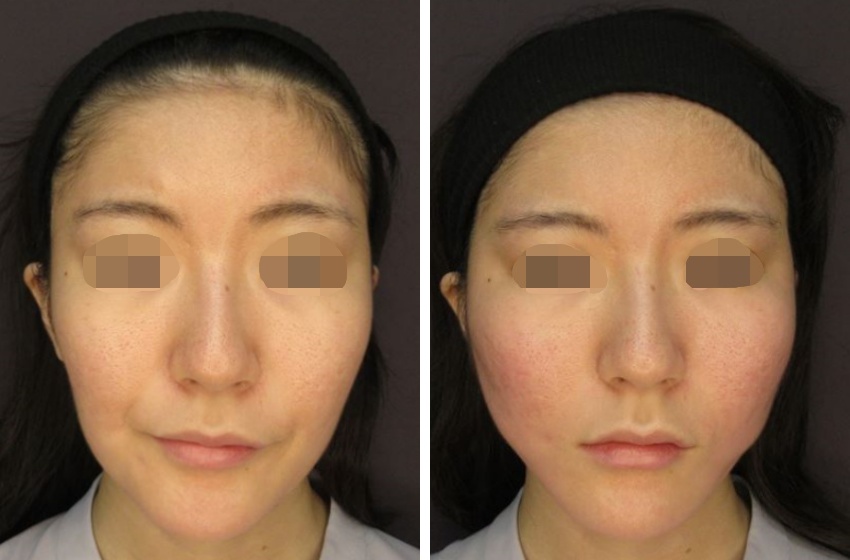 TAC式 ツヤ肌コラーゲンリフト®の症例写真 施術前後 直後