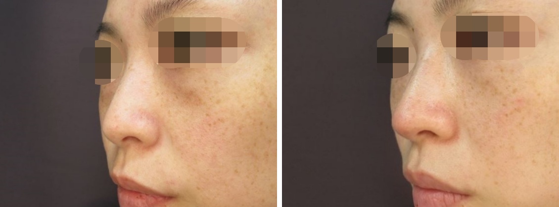 鼻尖4Dノーズ/鼻尖形成・鼻尖縮小の症例写真 施術前後 １ヵ月後