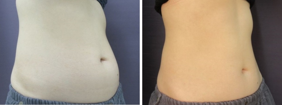 ダウンタイム無し！クラツーαでポッコリお腹撃退。