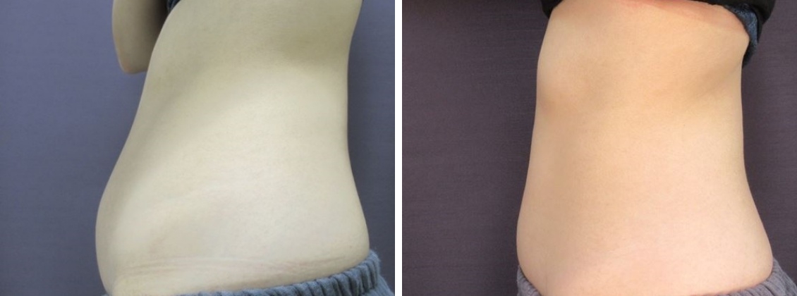 の症例写真 施術前後 1ヵ月後