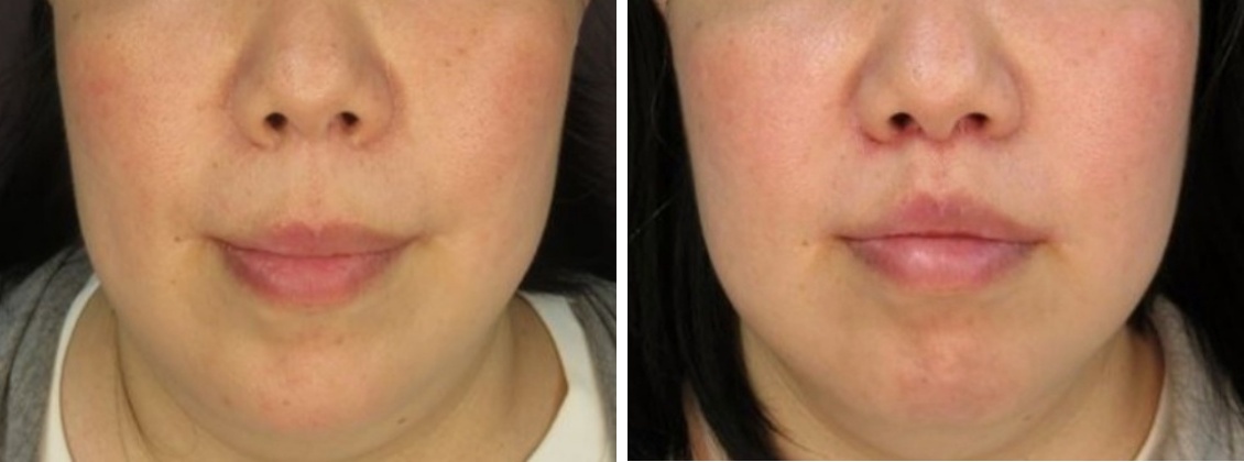 人中短縮術で若返りました