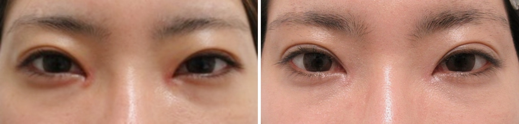 埋没法とマイクロ脱脂でナチュラルな二重に