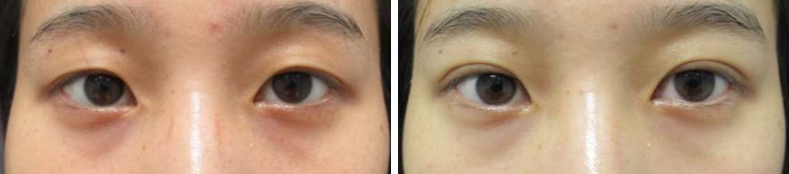 埋没法でアイプチ卒業し、パッチリ二重に