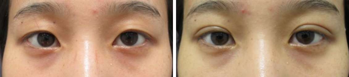 二重埋没法の症例写真 施術前後 １週間後