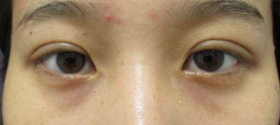 症例写真 ダウンタイム 埋没法でアイプチ卒業し パッチリ二重に Taクリニック 美容整形 美容外科 新宿 銀座 横浜 大阪 福岡 川越 高崎 Taクリニック 美容整形 美容外科