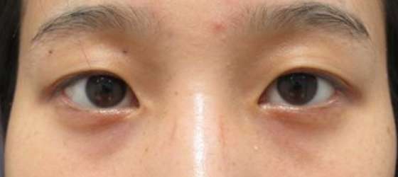 症例写真 ダウンタイム 埋没法でアイプチ卒業し パッチリ二重に Taクリニック 美容整形 美容外科 新宿 銀座 横浜 大阪 福岡 川越 高崎 Taクリニック 美容整形 美容外科 症例写真 ダウンタイム 埋没法でアイプチ卒業し パッチリ二重に Taクリニック 美容整形 美容外科 新宿 銀座 横浜 大阪 福岡 川越 高崎 Taクリニック 美容整形 美容外科