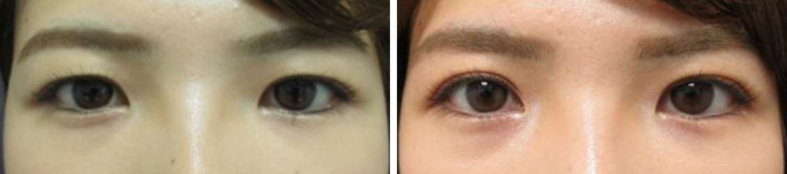 埋没法で“映える”お目元へ