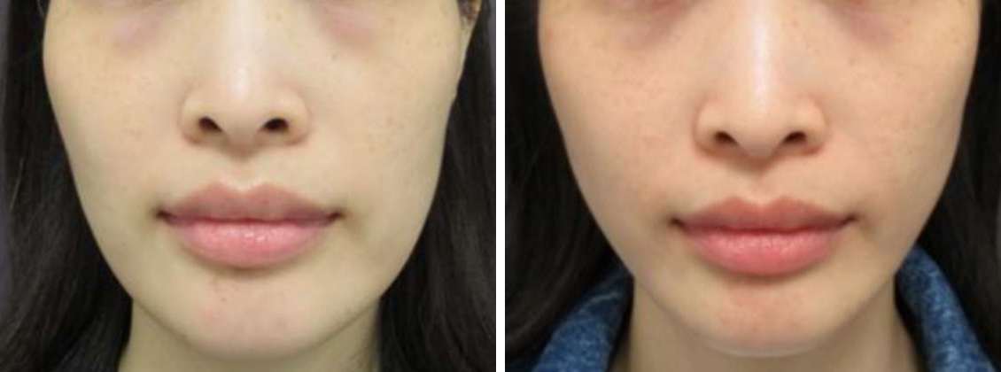 ツヤ肌コラーゲンリフトで土台から美しく