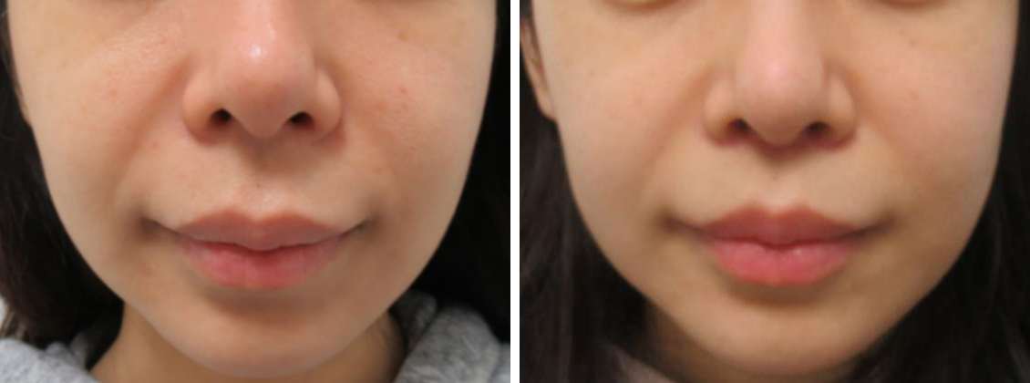 オーダーメイドの人中短縮術