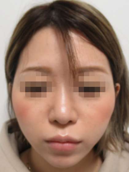 コラーゲンリフトとの組み合わせで自分史上最高の小顔へ 症例写真 Taクリニック 美容整形 美容外科 新宿 銀座 大阪 福岡 高崎