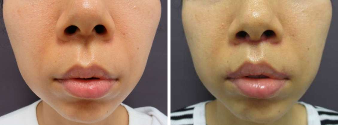 人中短縮術(リップリフト)・外側人中短縮術の症例写真 施術前後 1ヶ月後