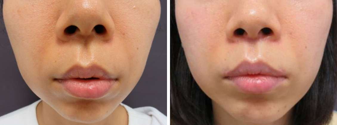 人中短縮術で若々しい口元へ