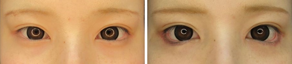 グラマラスライン切開×目尻靭帯移動で可愛らしいお目元に