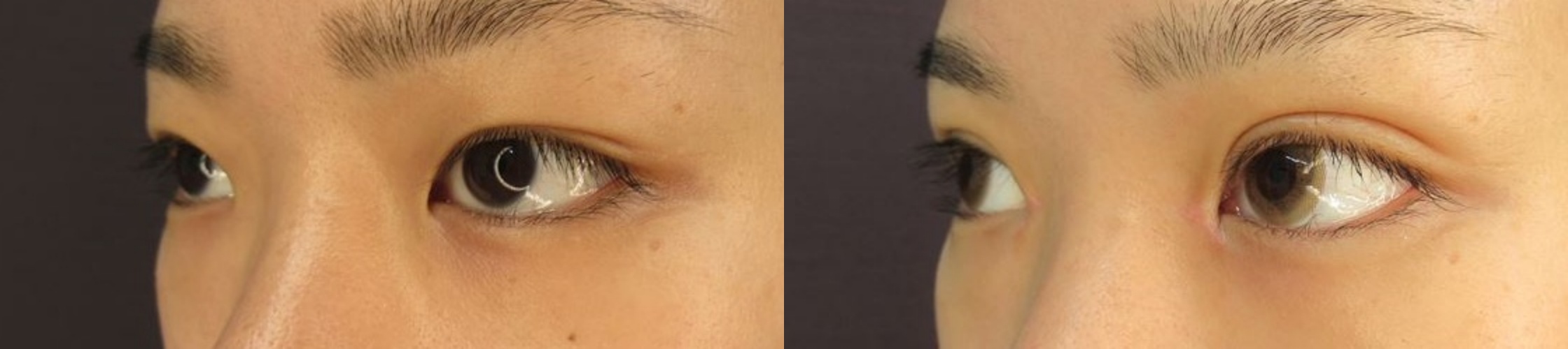 目頭切開+二重埋没でモテeyes