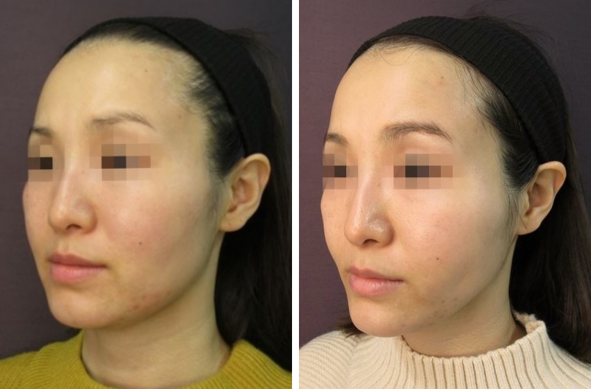 TAC式 ツヤ肌コラーゲンリフト®/ジョールファット除去/顎のヒアルロン酸注射の症例写真 施術前後 １ヵ月後