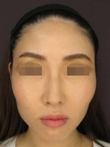 ツヤ肌コラーゲンリフト ジョールファット除去で輪郭がスッキリ綺麗になりました 症例写真 Taクリニック 美容整形 美容外科 新宿 銀座 大阪 福岡 高崎