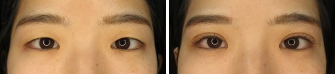 二重埋没法の症例写真 施術前後 2週間後