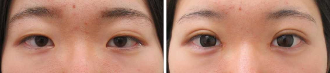 二重埋没法/目頭切開術/涙袋形成（ヒアルロン酸注射）の症例写真 施術前後 1ヵ月