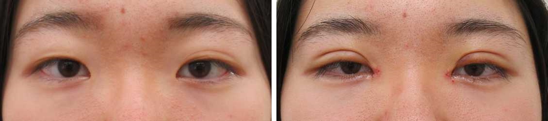 二重埋没法/目頭切開術/涙袋形成（ヒアルロン酸注射）の症例写真 施術前後 １週間