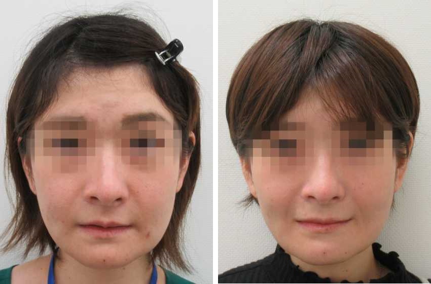 脂肪吸引の症例写真一覧 Taクリニック 美容整形 美容外科 新宿 銀座 大阪 福岡 高崎